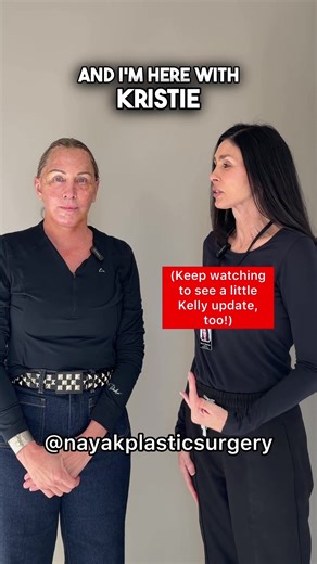 Transformation Journey: Kristie's Facelift Experience