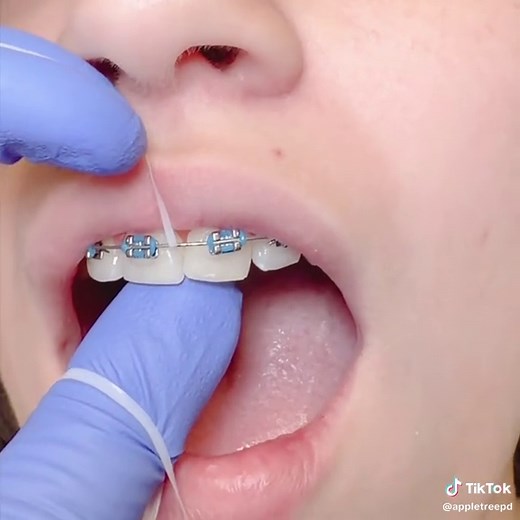 How to Floss with Braces: Part 1