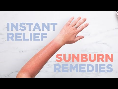 Instant Relief Sunburn Remedies