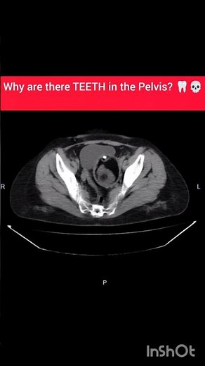 The Tumor with TEETH... 🦷👹 (Teratoma) #radiology #shorts#educational #neet