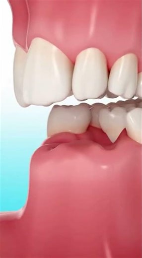 🦷 Will Your Teeth Move After a Tooth Extraction?