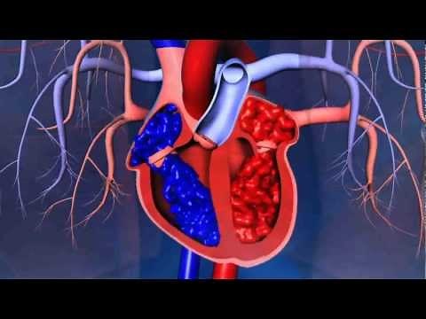What are the different types of heart surgeries?