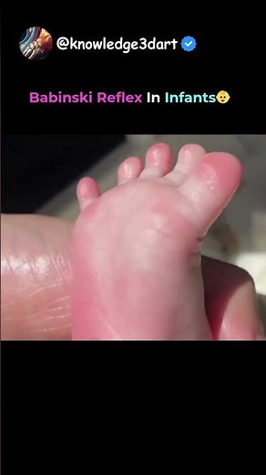 THIS IS HOW BABINSKI REFLEX LOOKS LIKE IN BABY👶