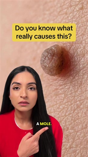 #skintagremoval #skintags #inflammation #prediabetes #insulinresistance