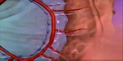 Cancer Colon Surgery Animation