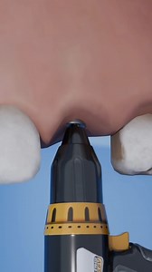 this is how artificial teeth are placed #how #artificial #teeth #placed | Universal SID