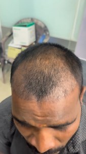 Hair transfer PRP monthly must 🧑 | Raja Sekar