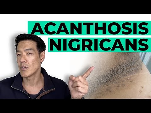 How to treat Acanthosis Nigricans | Dr Davin Lim