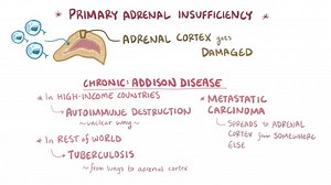 Video: Primary adrenal insufficiency - Video Explanation! | Osmosis | Osmosis