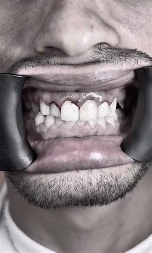 Dent Cassée ? Implant et Dent Fixe en 1 Seul Jour 🦷🇩🇿 (Avant/Après)