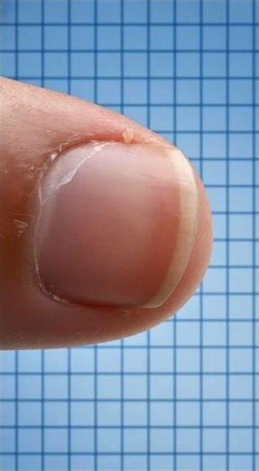 Why You Should NEVER Pull Out a Hangnail 😳 #tejtapes #shorts