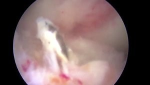 Anatomic ACL Reconstruction using Independent Tunnel, Outside-In, Interference Screw Technique