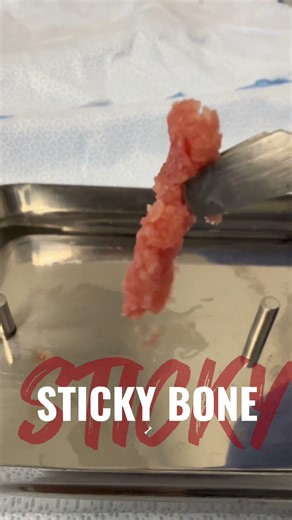 PRF Sticky Bone
