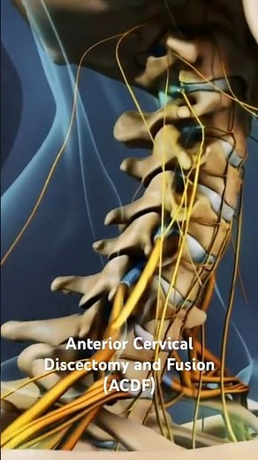Anterior Cervical Discectomy and Fusion (ACDF)