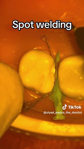 Spot Welding Trick for Matrix Collapse in Large Cavities