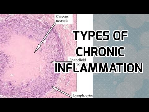 Types of chronic inflammation