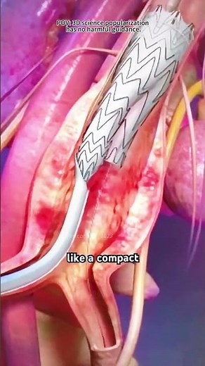 Endovascular Aneurysm Repair (EVAR). (3D Animation)