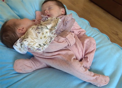 'Miracle' Northern Irish Conjoined Twins Are Separated