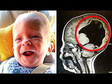 Boy Born Without A Brain, 6 Years Later Look At What Doctors Find Inside