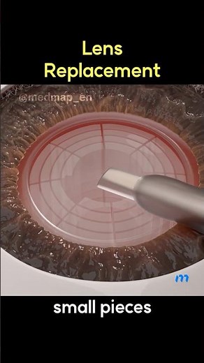 What's a Cataract? | 3D Animation