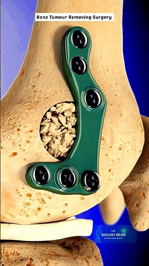 Bone Tumor Surgery Explained | 3D Medical Animation #shorts #bonetumors