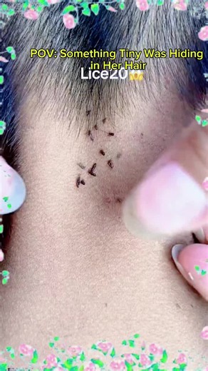 How to Find and Treat Head Lice After Shaving Hair