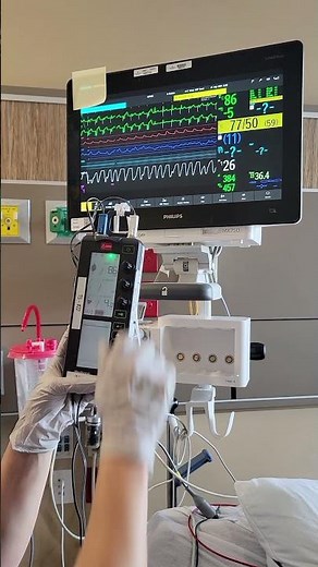 Epicardial Pacemaker