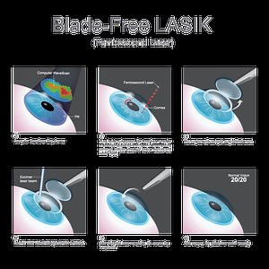 LASIK Las Vegas | Bladeless LASIK Las Vegas | Shepherd Eye