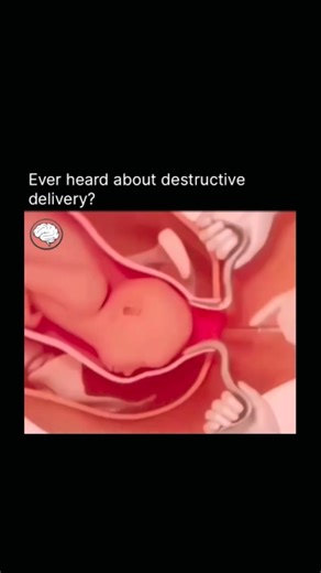 How Everything Works | Destructive delivery refers to a set of emergency obstetric procedures performed only when the fetus has already died in the uterus and... | Instagram