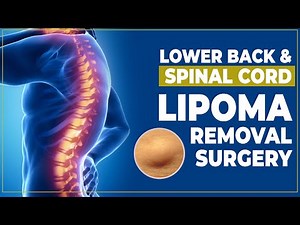 Lower Back & Spinal Cord Lipoma Removal Surgery | Dr. PK Talwar | Lipoma Removal Surgery in Delhi