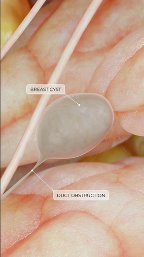 Could a harmless lump in your breast reveal something about your hormones? Breast cysts in 3D