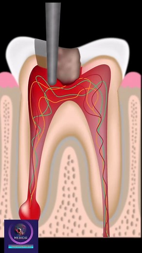 13K views · 70 reactions | Root Canal Treatment in 3D Animation #rootcanal #fbreelsvideo #foryou #animation | Medical Animation Media | Facebook