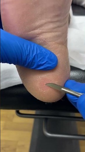 Expert Heel Corn and Callus Removal by Australian Podiatrist | Effective Solutions with Ergonx