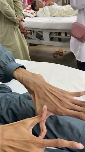 Wrist sign & steinberg sign