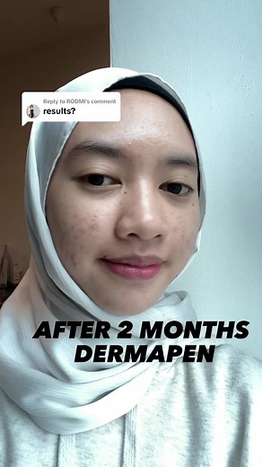 Replying to @RODMI Skin is recovering. before the dermapen Acne treatment there were too many active acne pimples, but after the dermapen Acne the acne production decreased. I will update her skin condition from time to time. Tq😊