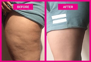 Cellulite Cupping Before and After Photos That Will Make You a Believer