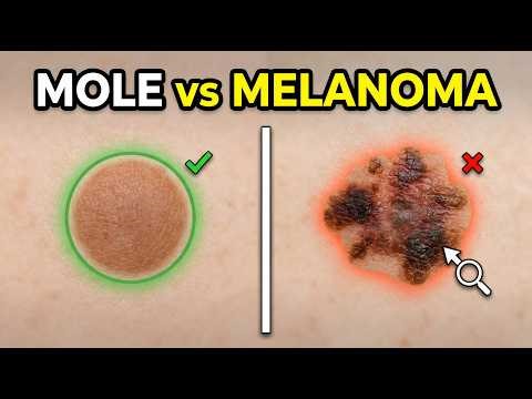 Mole or MELANOMA?... We all NEED to know the difference 🧐