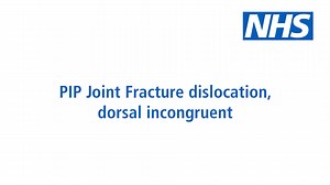 PIP Joint Fracture dislocation, dorsal incongruent