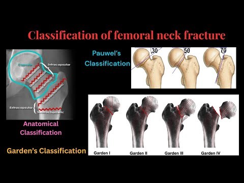 Classification of femoral neck fracture: Anatomical, Pauwel’s, and Garden’s Classification.