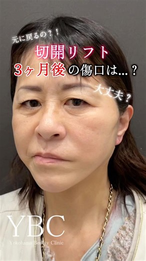 What do the incisions look like 3 months after a facelift...? #CosmeticSurgery #Facelift #ybcYoko...