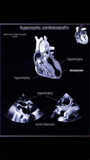 1.3K views · 83 reactions | Hypertrophic Cardiomyopathy (HCM) is a...