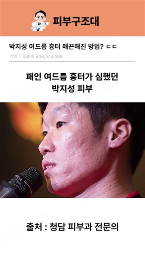 박지성 여드름 흉터 매끈해진 방법?ㅣ피부과시술, 피부과레이저, 청담피부과, 큐어트라, 울트라클리어, 큐어젯, 조합시술, 여드름흉터, 여드름, 흉터, 흉터치료