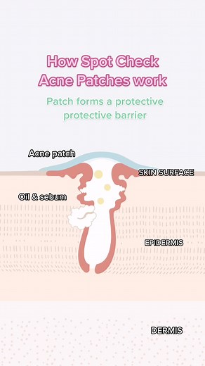 Cómo funcionan los parches de acné Spot Check