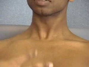 tracheal deviation