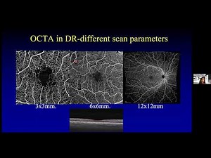 OCT-A Imaging to Identify Proliferative Diabetic Retinopathy