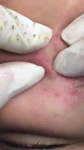 I can watch this all day long without boring 😂 | Pimple Popping videos