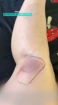 Spider Bite Progression