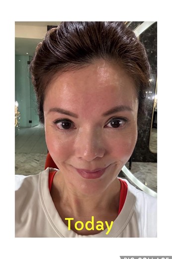 How to grow new hair & increase collagen at 50 ✨ 4 months ➡️ 30 mins daily ➡️ BIG results! ✨ 🌱 White baby hairs? Gone. 🙌 Hair loss? Stopped. ✨ New growth (right side so obvious 👀). 💖 Bonus glow: skin feels firmer & smoother. Consistency = results. Celluma works for BOTH hair   skin 💡 FB: Celluma Malaysia IG : Celluma Malaysia (Official) TikTok: Celluma.Malaysia DM / WhatsApp only:  60123385588 #celluma #redlighttherapy #ledlighttherapy #hairgrowthjourney #rambutbaru #rambutsehat #botaksolut