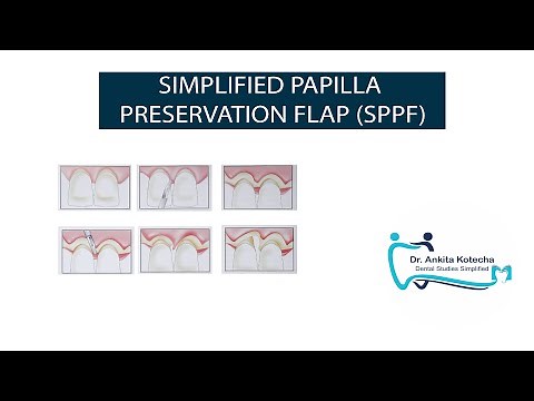SIMPLIFIED PAPILLA PRESERVATION FLAP (SPPF)|MINIMALLY INVASIVE PERIODONTAL SURGICAL TECHNIQUES