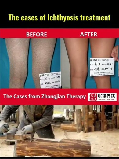 The cases of ichthyosis treatment #ichthyosisvulgaris #ichthyosistreatment #ichthyosis